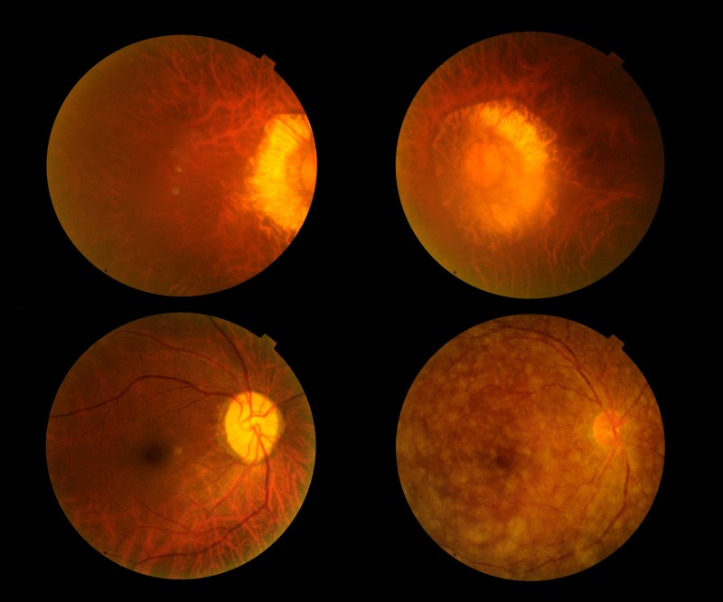 Retina when examining the back of the eye